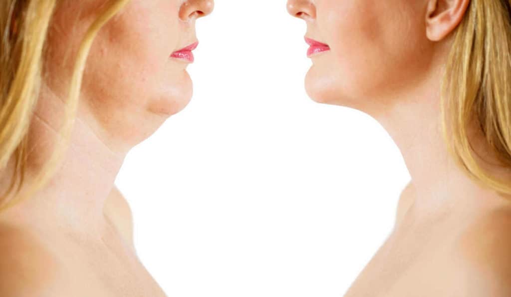 Double Chin treatment Upper Sydenham before and after results