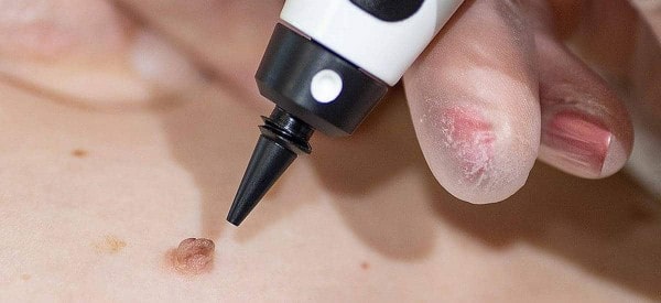 After Skin Tag Removal Upper Sydenham