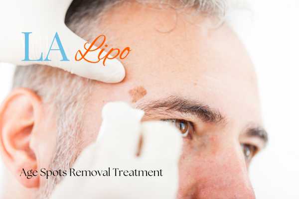 What Are the Most Effective Treatments for Age Spots Upper Sydenham?