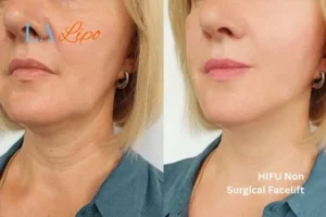 hi-fu for wrinkles Upper Sydenham before and after results