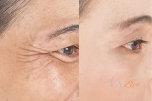 Before and after results of woman - HI-fu wrinkles reduction treatment Upper Sydenham