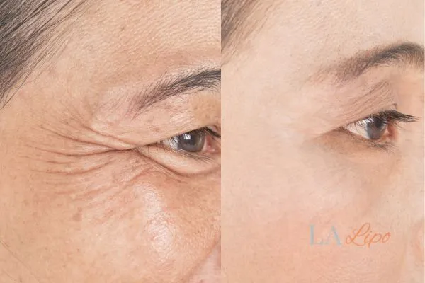 Before and after results of woman - HI-fu wrinkles reduction treatment Upper Sydenham