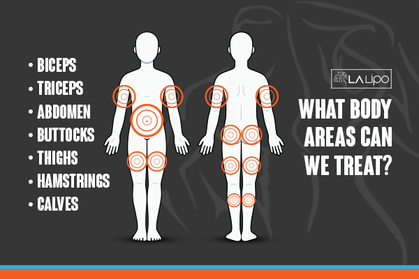 Graphic to show areas you can have LA-EMS Body Sculpting Upper Sydenham treatment.