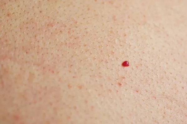 close up of a cherry angioma Upper Sydenham