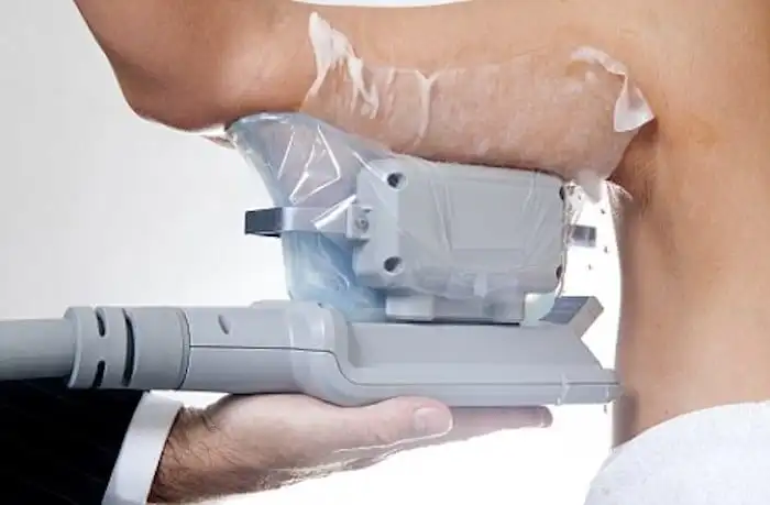 Picture of fat freezing Upper Sydenham on the upper arms.