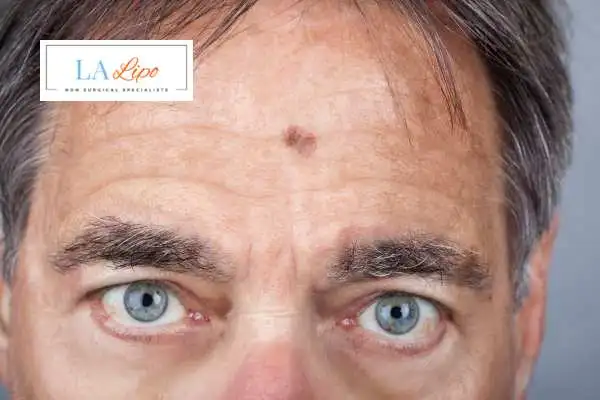 Solar Lentigo Removal Upper Sydenham image of man with mark on his forehead