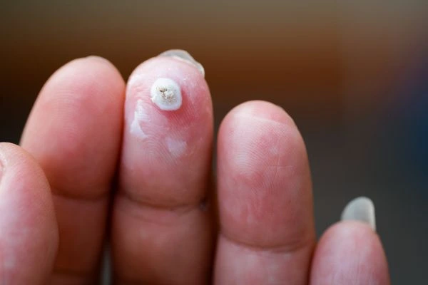 wart on person finger - cryotherapy to treat from LA LIPO Upper Sydenham