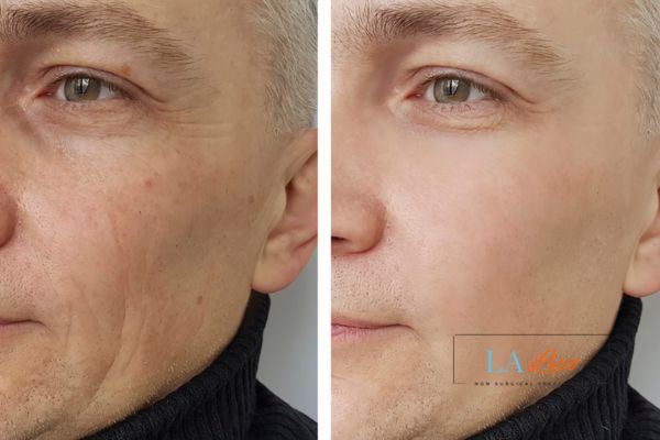 See the amazing results of Morpheus8 Treatment Upper Sydenham!