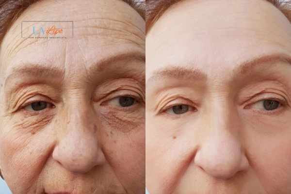 The powerful benefits of Morpheus8 Treatment Upper Sydenham - Call Our team today!