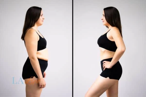 Picture of womans before and after using LA-EMS body sculpting to improve her core strength Upper Sydenham