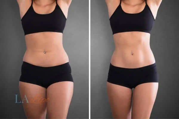 before and after results of non-surgical treatment to help a woman's body image and mental health Upper Sydenham
