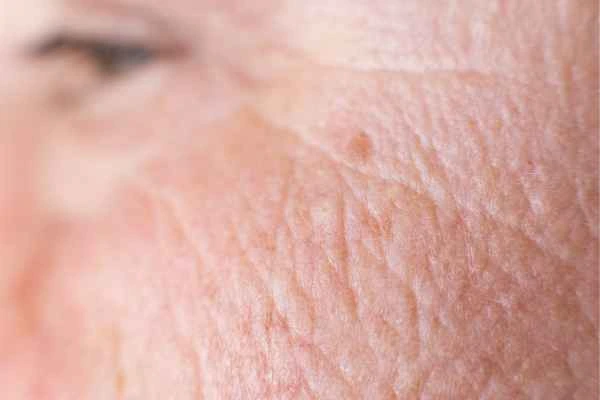 close up picture of a woman's face showing an age spot Upper Sydenham