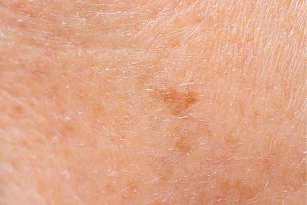 close up picture of age spots Upper Sydenham