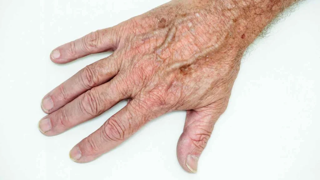 Male hand showing age spot Upper Sydenham