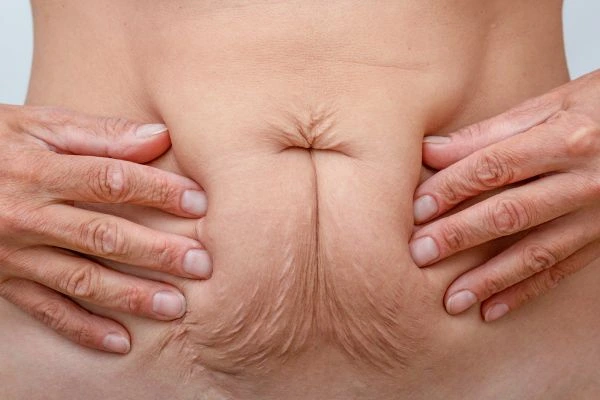 Should I Combine Diastasis Recti Treatment with Body Contouring for Better Results Upper Sydenham?