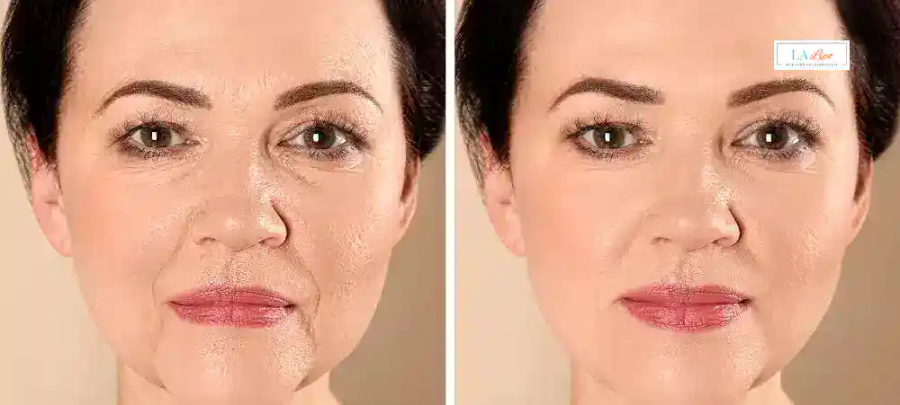 How Long Does It Take to See Results and How Long Do They Last Upper Sydenham?