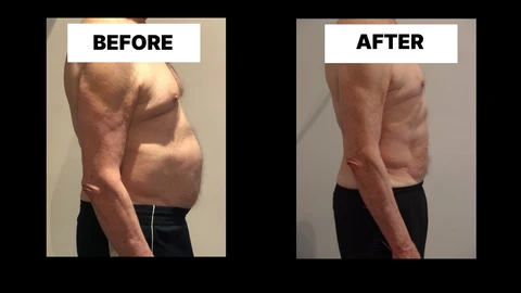 What Symptoms Can Diastasis Recti Cause in Men? Weak Core, Back Pain and Poor Posture Upper Sydenham